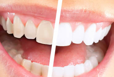 Teeth Whitening Trends