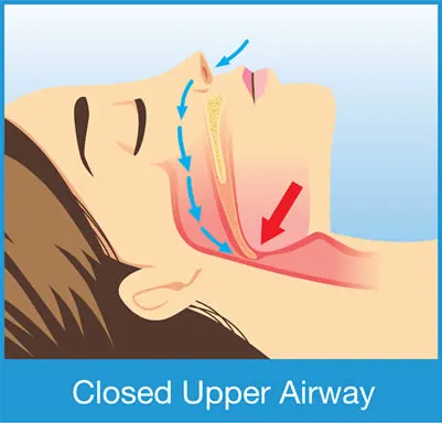 closed airway sleep apnea diagram