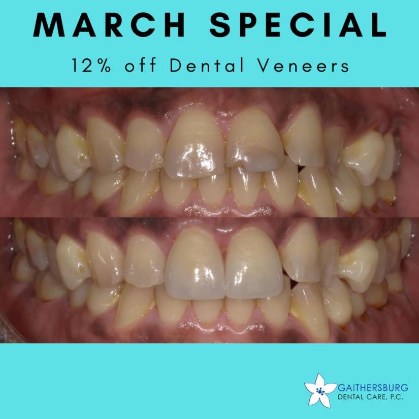 march special dental veneers