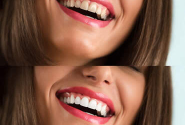 Make Your Big Day Special With Teeth Whitening