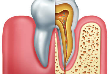 Restoring Your Oral Health Through Root Canal Therapy
