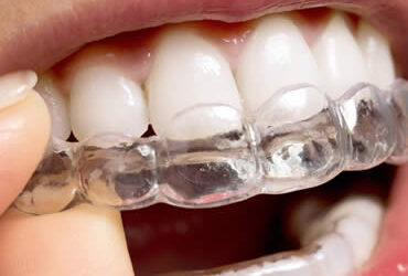 Getting a Stylish New Smile through Invisalign