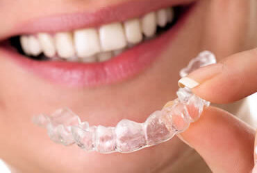 Adults: Living with Invisalign