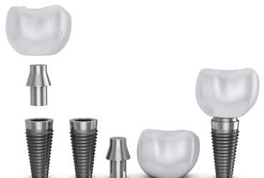 Dental Implant FAQ