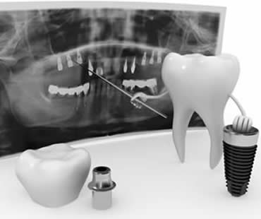 Why More People are Turning to Dental Implants